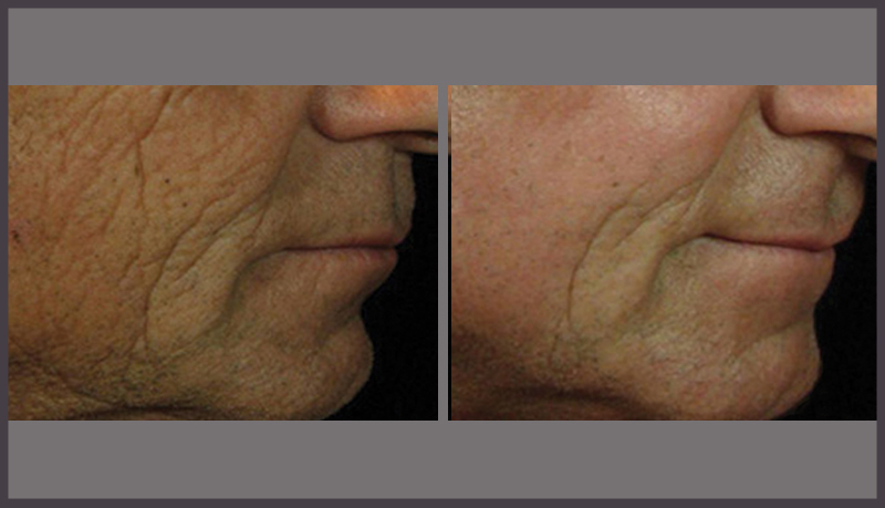 Men-wrinkles-treatment-calgary