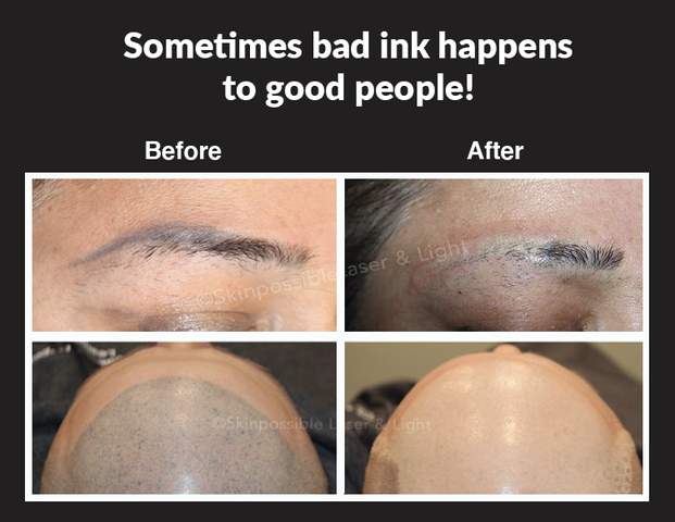 cosmetic ink removal calgary ink tattoo removal
