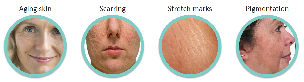 microneedling skin conditions